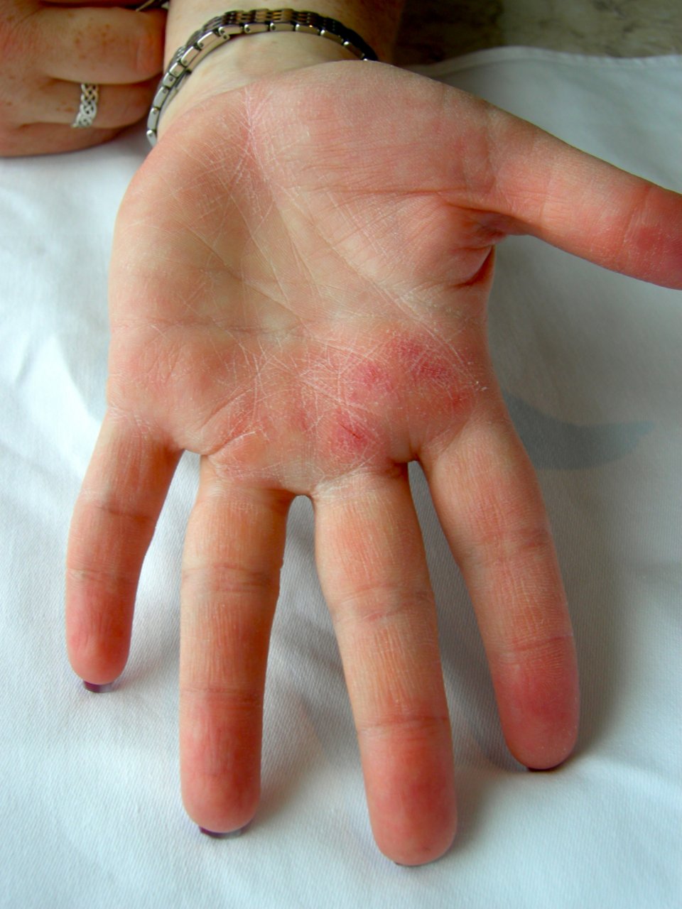 Cynthia clapped so much at the last Great Big Sea show, she broke skin!