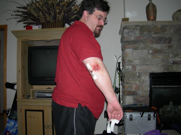 Matt shows off his battle scar